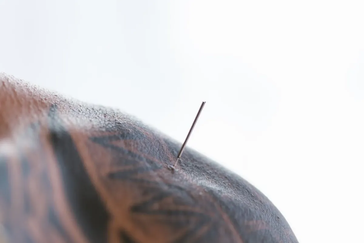 Dry needling for trigger points compared to shockwave therapy